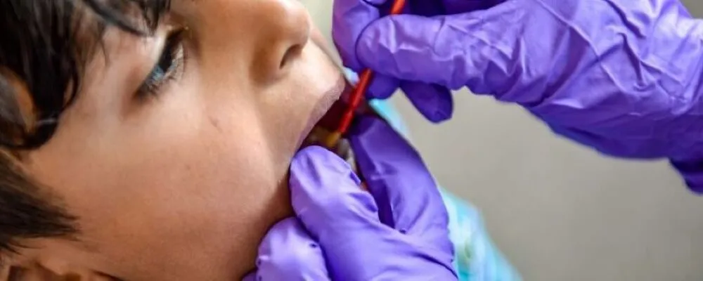 A photograph of a child receiving fluoride varnish on their teeth