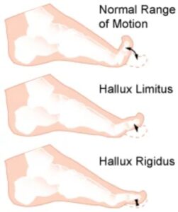 Graphic showing restrictions in movement of the big toe caused by osteoarthritis