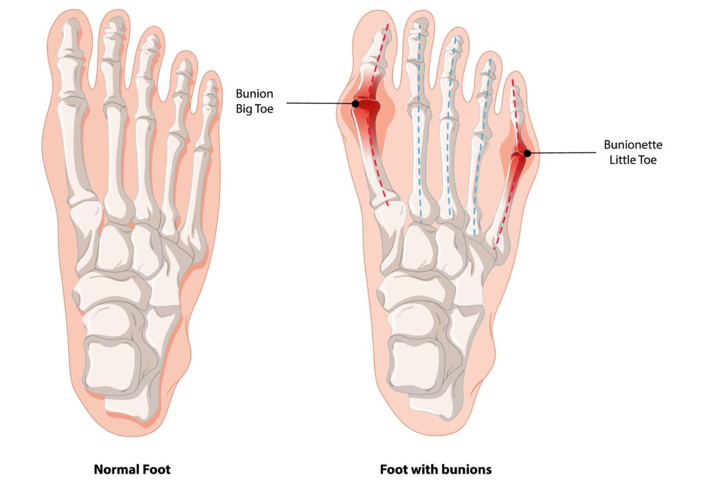 Graphic showing the bony deformity of a bunion
