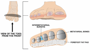 Graphic showing intermetatarsal bursitis