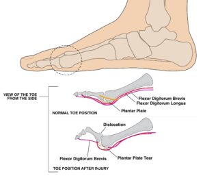 Illustration of a plantar plate injury
