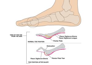 Graphic showing the plantar plate