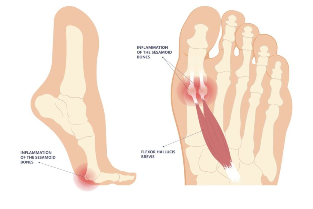 Graphic showing sesamoiditis inflammation