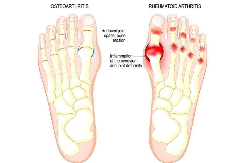 Graphic showing osteoarthritis and reumatoid arthritis in the toes