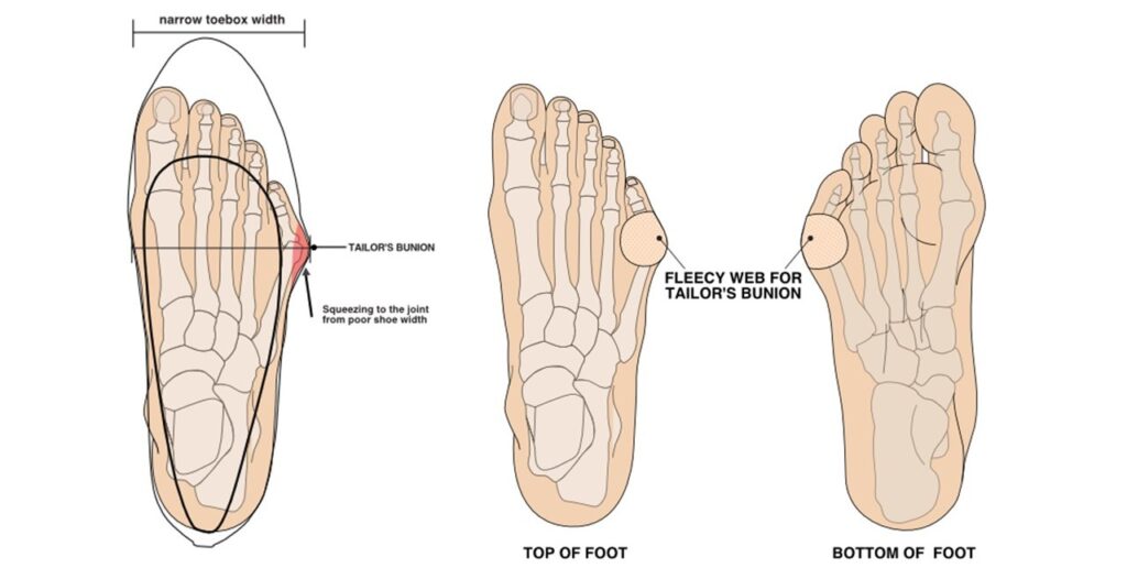 Image showing footwear and padding to relieve pain of bunionette