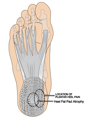 Image showing areas of pain with fat pad syndrome and plantar heel pain