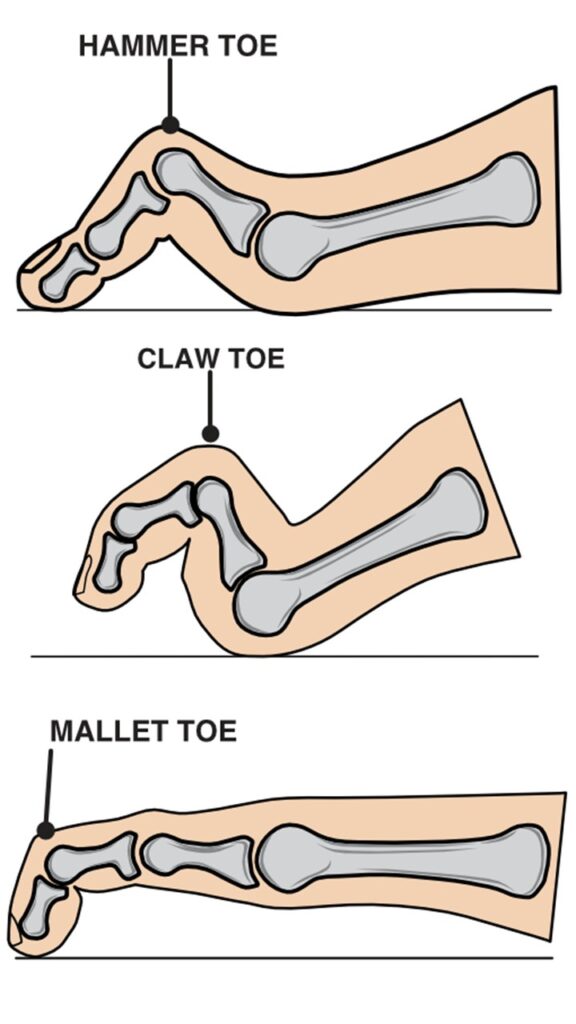 Graphic showing the difference between hammer, claw and mallet toe