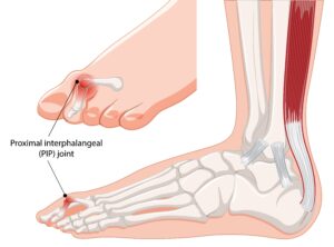 Graphic of hammer toe