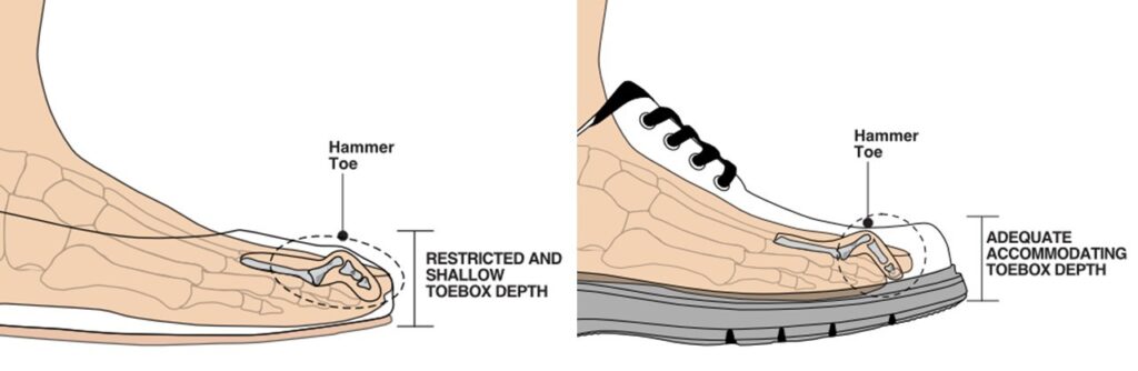 graphic showing correct depth of shoe's toebox for people experiencing hammer toe
