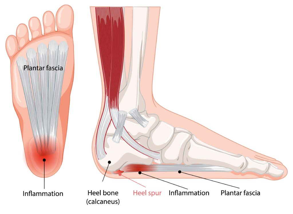 Illustration of plantar heel pain and heel spur