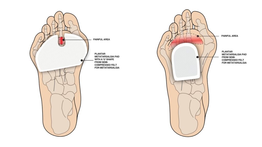 pain-in-your-toe-or-the-ball-of-your-foot-metatarsalgia-bradford