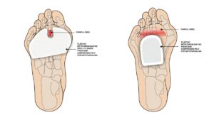 Graphic showing correct positioning of pads which can be used to relieve pain in the ball of the foot
