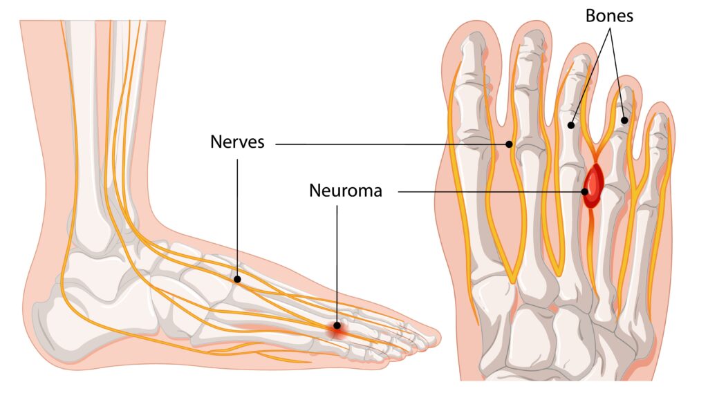 Graphic showing symptoms of Morton's neuroma - nerve thickening in the foot
