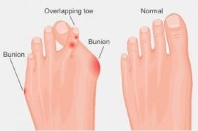 Graphic showing normal and overlapping toes