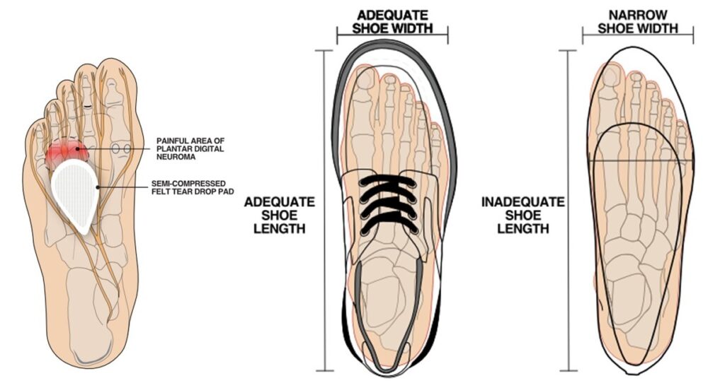 Image showing padding and shoes to relieve the pain of Morton's neuroma