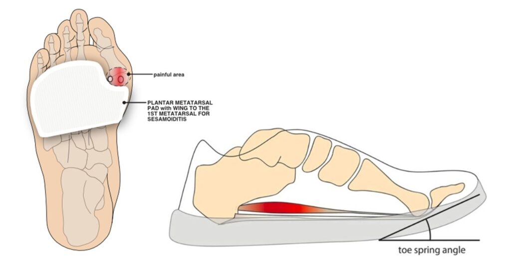 Image showing padding and shoe fit to relieve pain of sesamoiditis