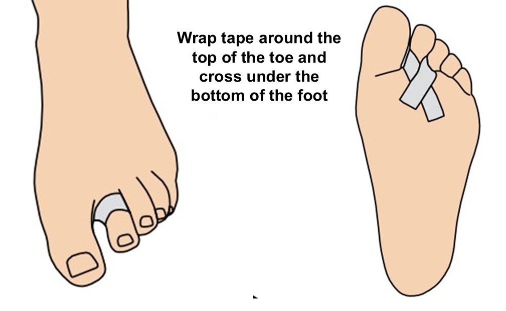Illustration of how to strap a toe